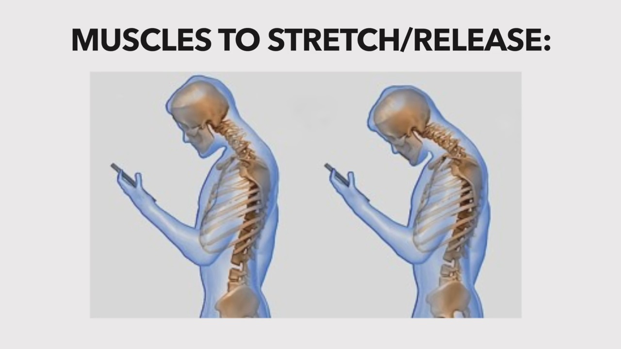 How Long Does It Take To Correct Forward Head Posture